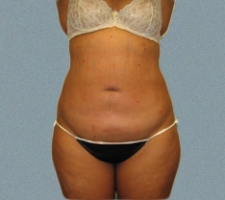 Abdomen Patient 2