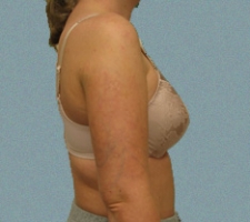 patient10_after2