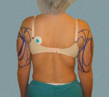 patient10_before3_drawing