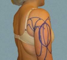 patient10_before4_drawing