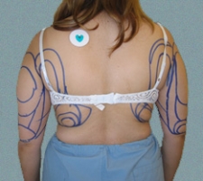 patient9_before2_drawing