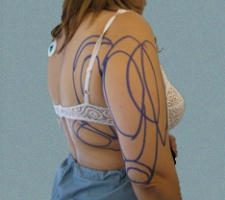patient9_before3_drawing