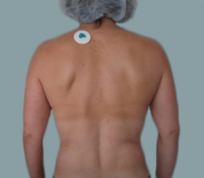 patient1_before1