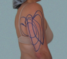 patient1_before2