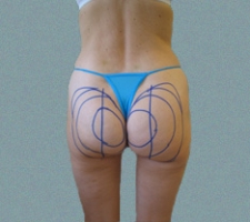 patient10_before3_drawing