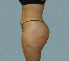 Buttocks Patient 2