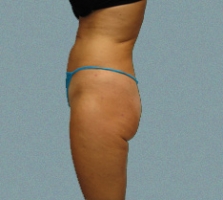 Buttocks Patient 3