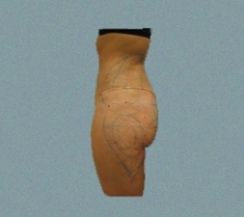 Buttocks Patient 4