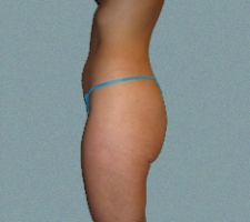 patient5_after1_2months