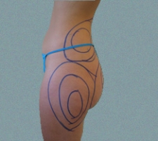 patient5_before3_drawing
