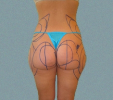 patient5_before4_drawing