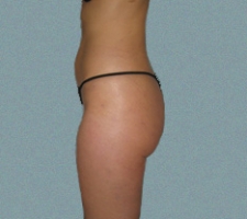 Buttocks Patient 6