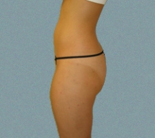 Buttocks Patient 8
