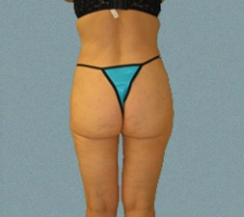Buttocks Patient 9