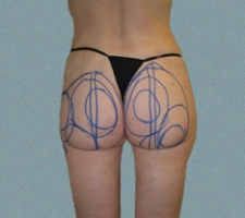 patient9_before4_drawing