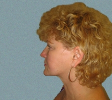patient10_after1_2months
