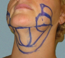 patient10_before3_drawing