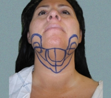 patient5_before3_drawing
