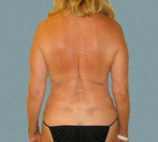 Female Back Patient 1
