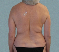 patient1_after3_2months