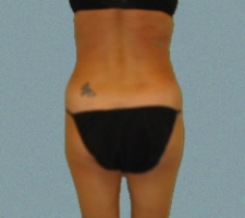 Female Back Patient 10