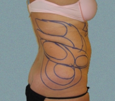 patient10_before3_drawing