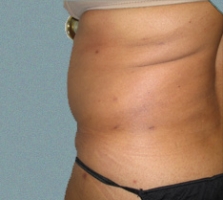 Female Back Patient 2