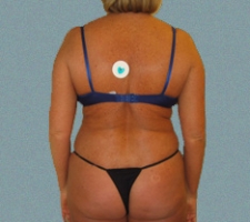 Female Back Patient 3