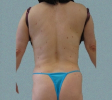 Female Back Patient 4