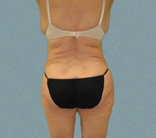 Female Back Patient 5