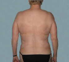 Female Back Patient 6