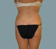 Female Back Patient 7