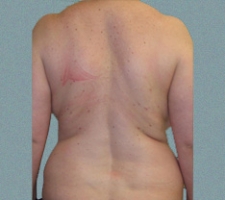 Female Back Patient 8