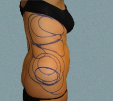 patient9_before2_drawing