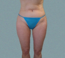 patient1_after1_5months