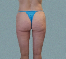 patient1_after2_5months