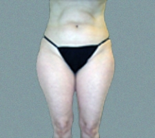 patient1_before1