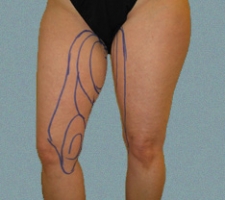 patient1_before3_drawing