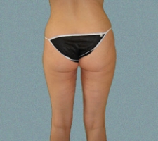 Inner Thigh Patient 17