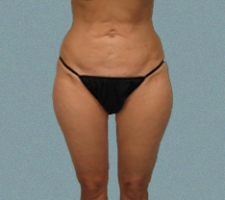 patient2_after4_6weeks