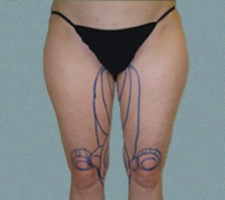 patient2_before3_drawing