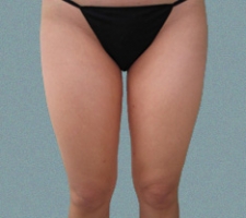 Inner Thigh Patient 7