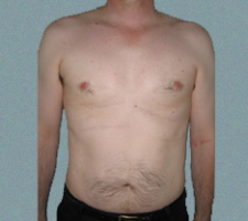 Male Breast Patient 1