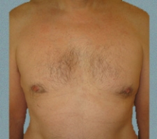 Male Breast Patient 10