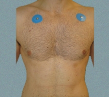 Male Breast Patient 2