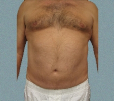Male Breast Patient 3