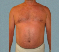 patient4_after2