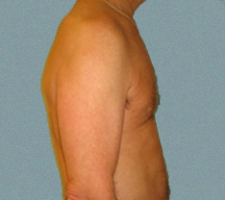 patient5_after1