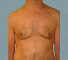 patient5_after2