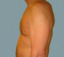 Male Breast Patient 5
